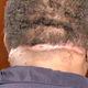 Image for article titled Dr. Pimple Popper and the Half-Head Removal